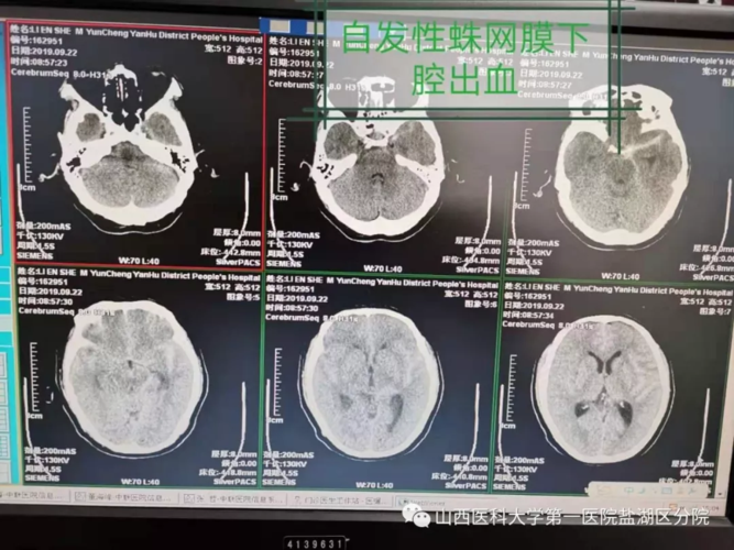 脑血管介入手术费能报销吗？（郑州三附院治疗血管瘤怎么样）