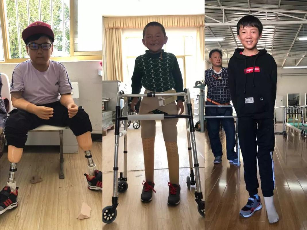 舒洁假肢有限公司技术怎么样？（大学假肢矫形工程怎么样）